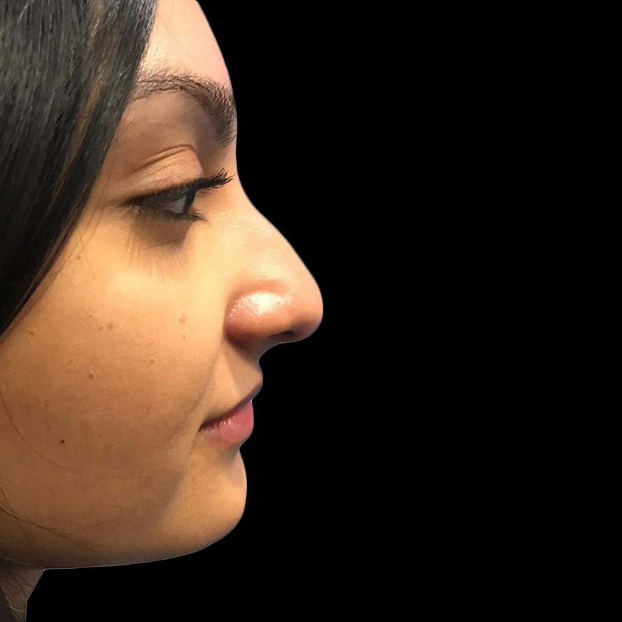 Case--21226 | Before Face