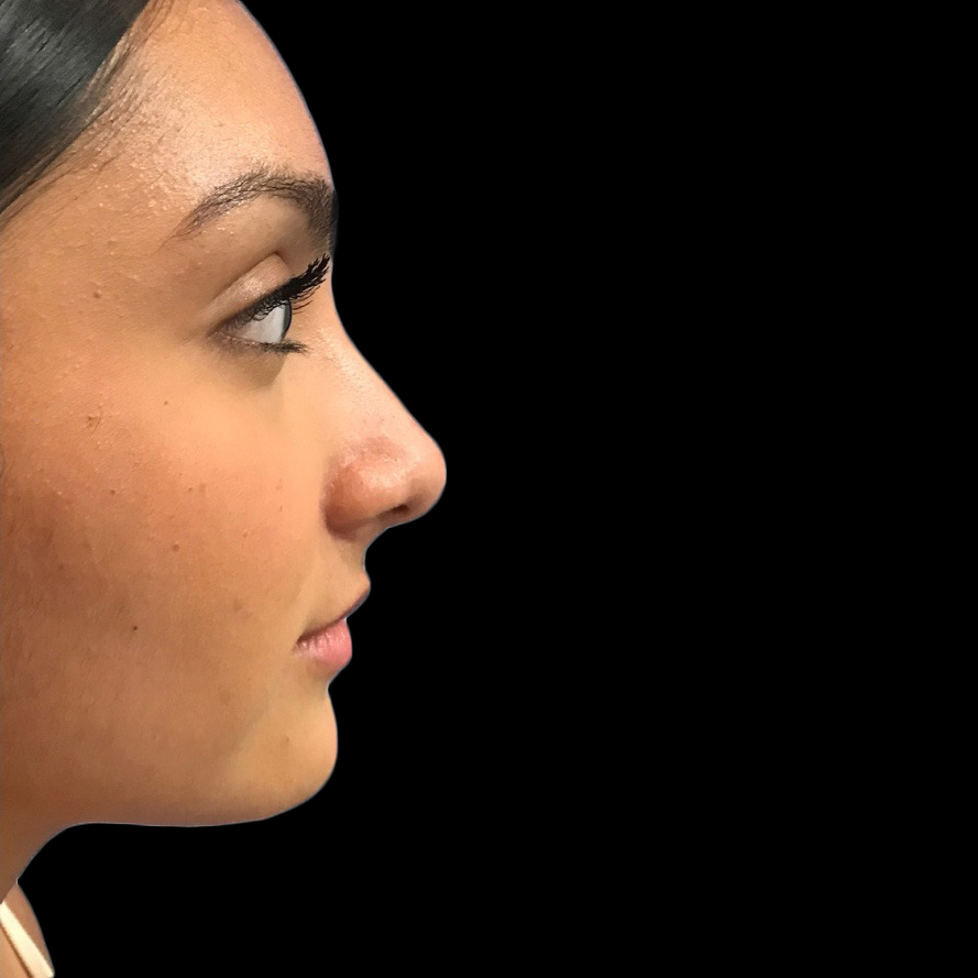 Case--21226 | After Face