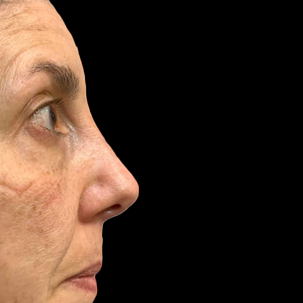 Case--21227 | After Face