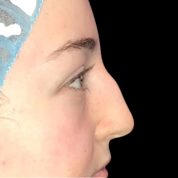 Case--21228 | Before Face