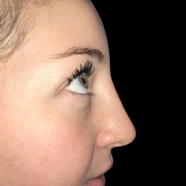 Case--21228 | After Face