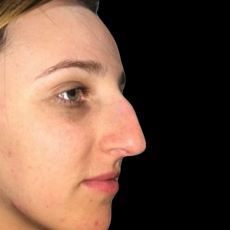 Case--21233 | Before Face