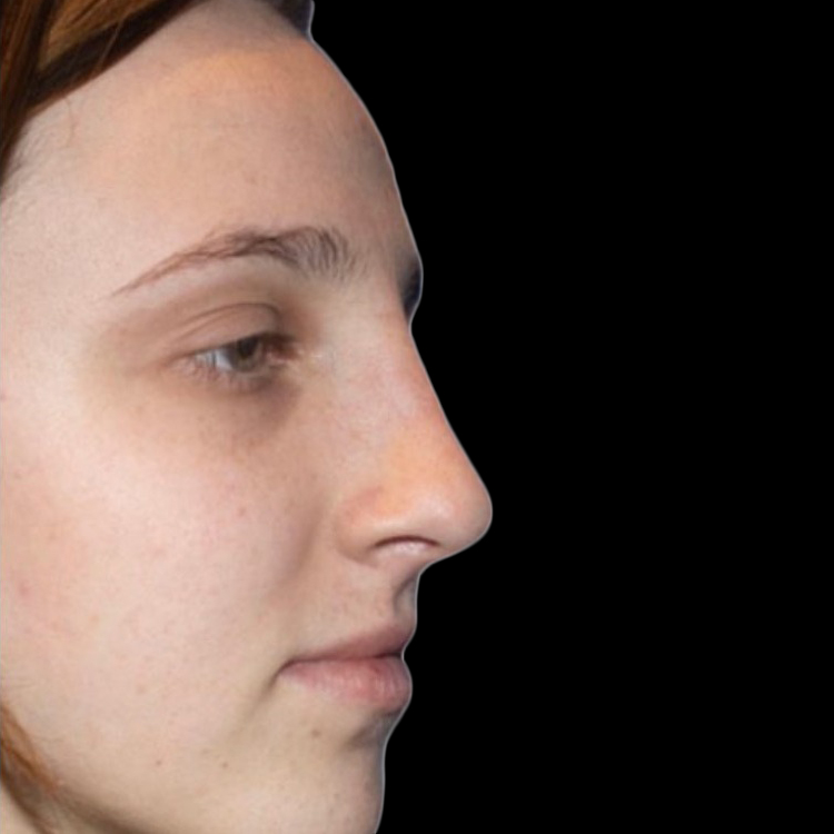 Case--21233 | After Face