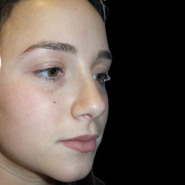 Case--21234 | After Face