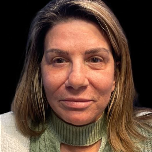 Case--9886 | After Face