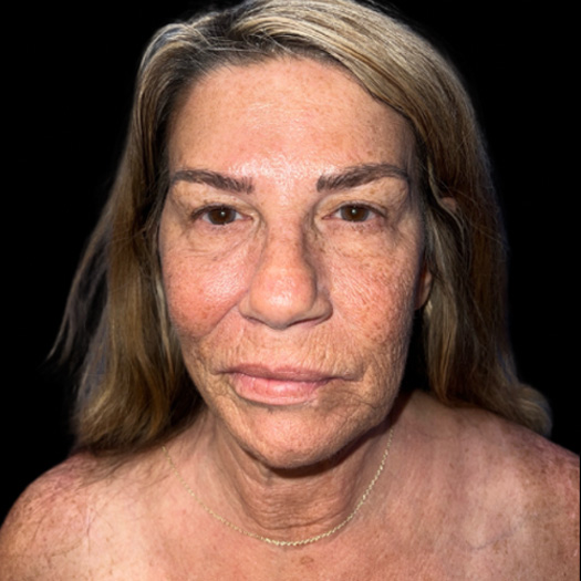 Case--9886 | Before Face