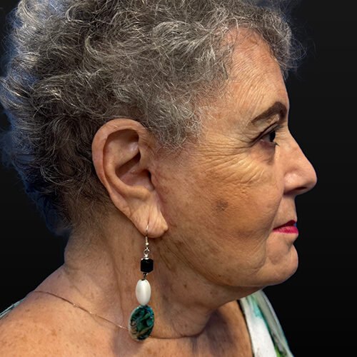 Case--6773 | After Face