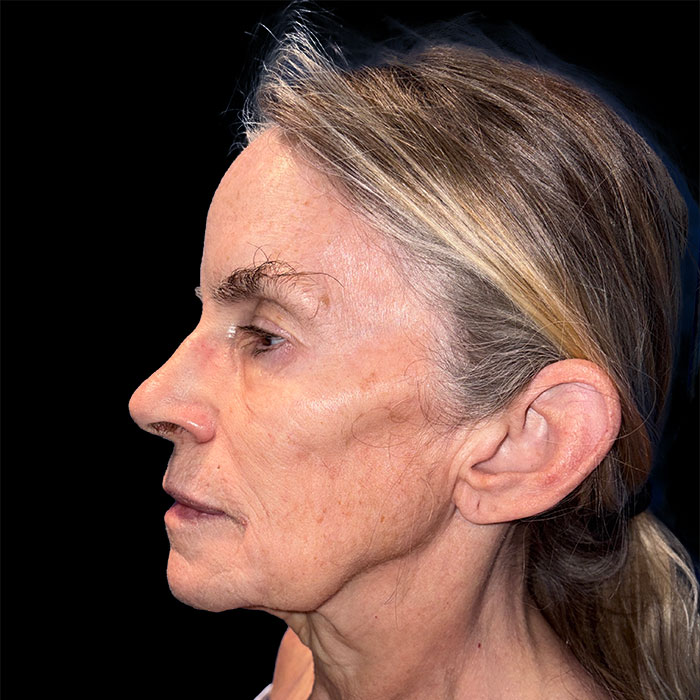 Case--2143 | Before Face