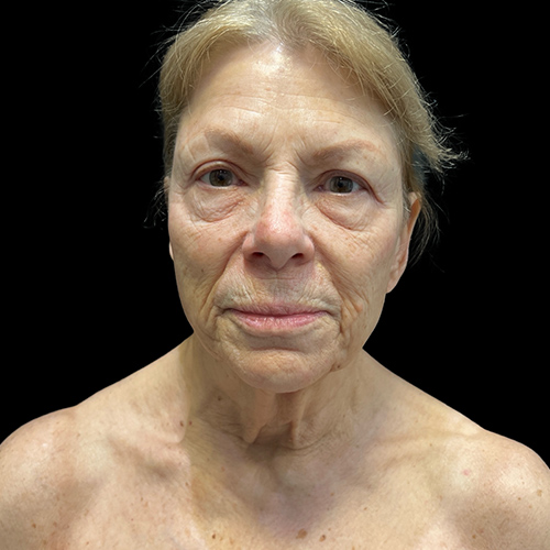 Case--1789 | Before Face