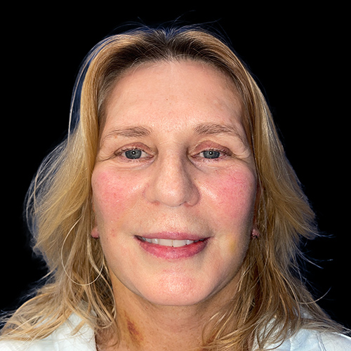 Case--1530 | After Face