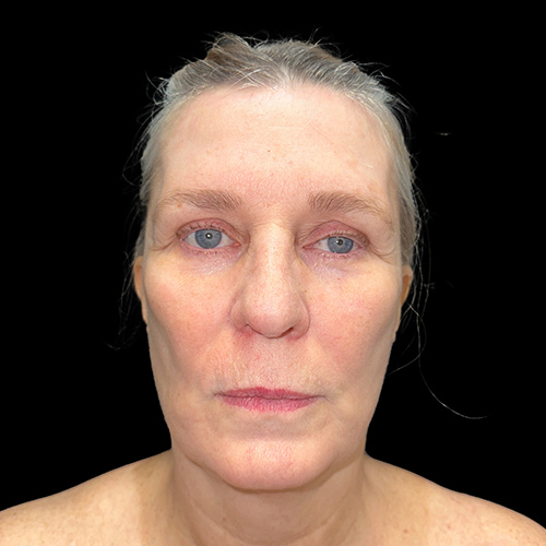 Case--1530 | Before Face