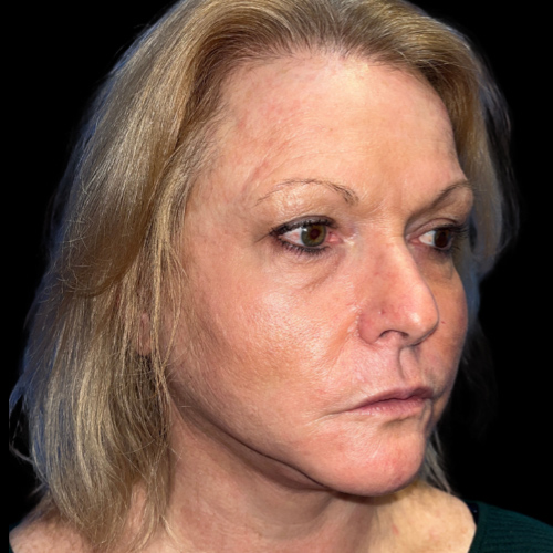 Case--9889 | After Face