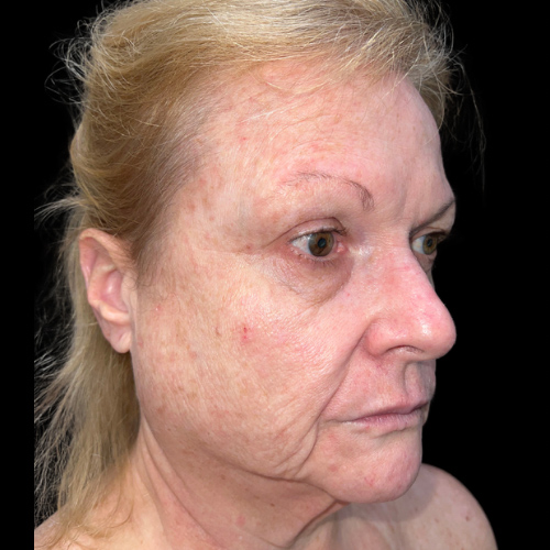 Case--9889 | Before Face