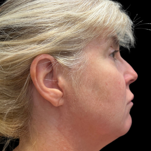 Case--6044 | Before Face