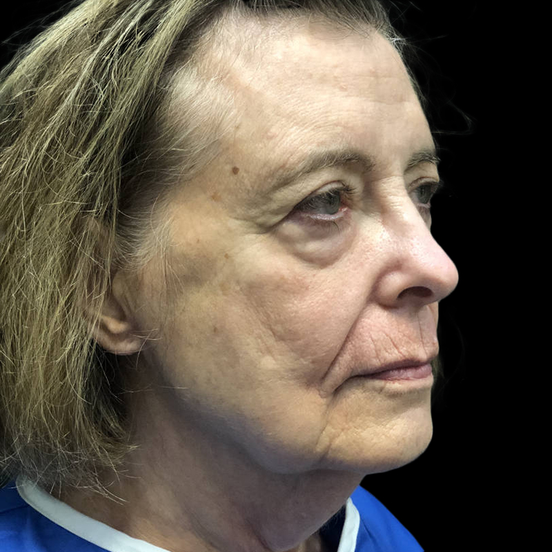 Case--19580 | Before Face