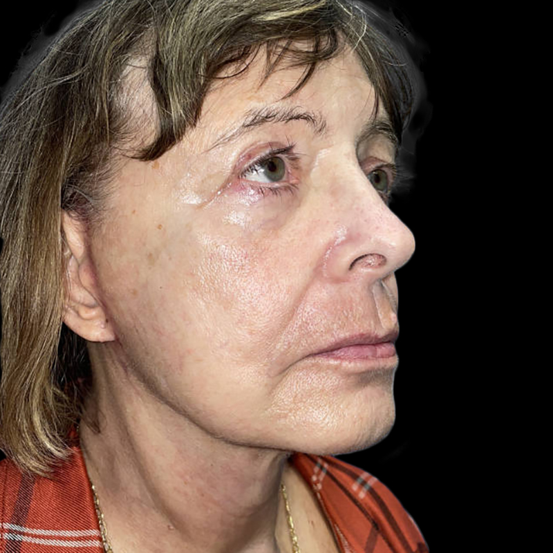 Case--19580 | After Face