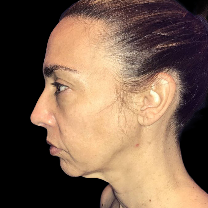 Facelift Before and After 1a