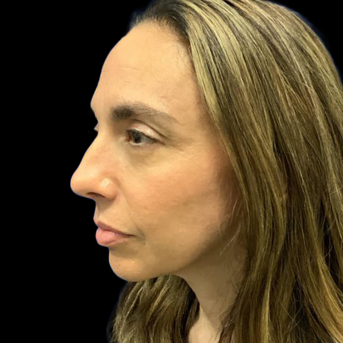 Facelift Before and After 1b