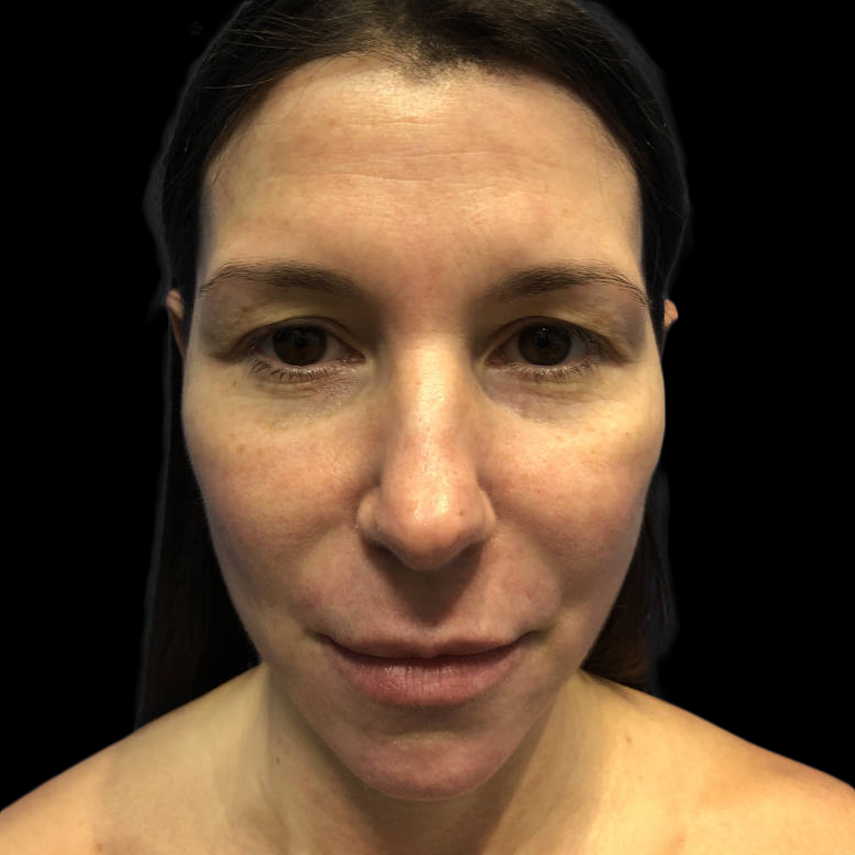 Case--19359 | Before Face