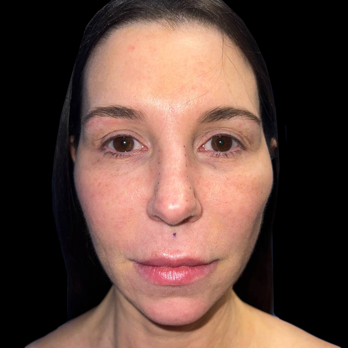 Case--19359 | After Face