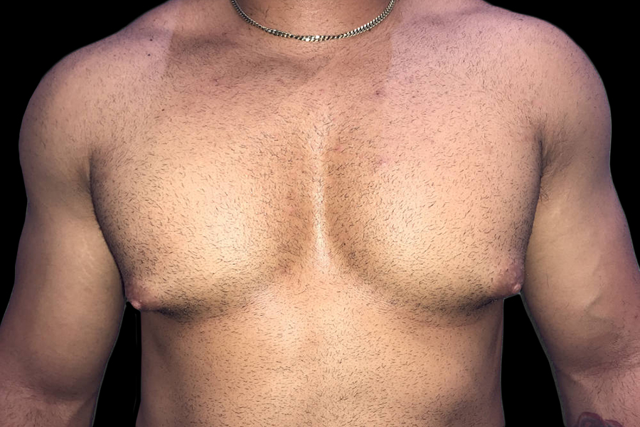 Case--19386 | Before Gynecomastia