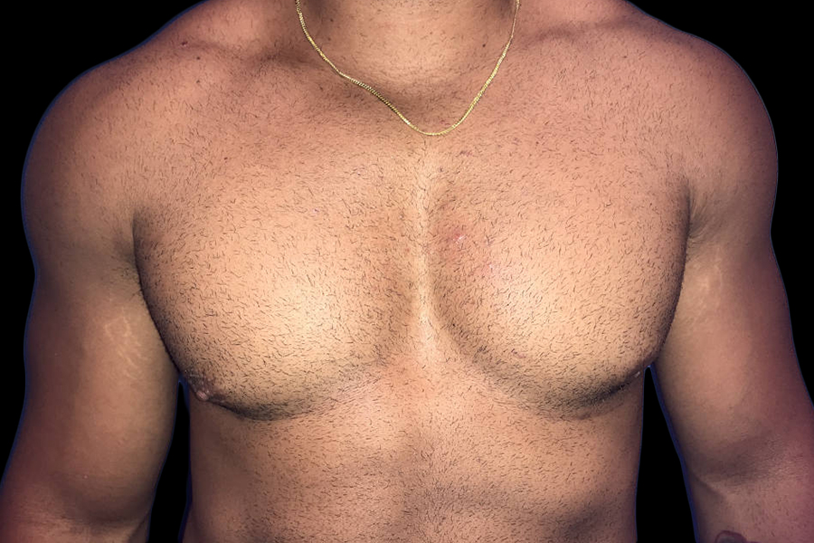 Case--19386 | After Gynecomastia