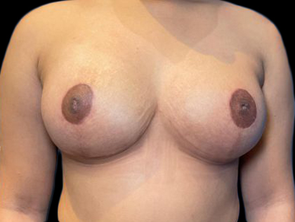 Case--22178 | After Breast Reduction