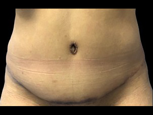 Case--21265 | After Tummy Tuck