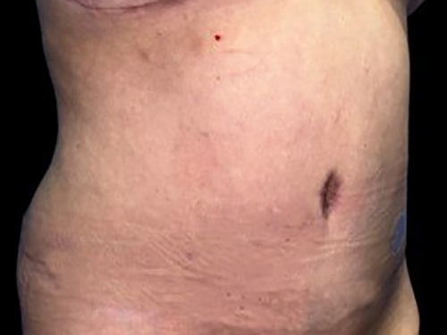 Case--21260 | After Tummy Tuck