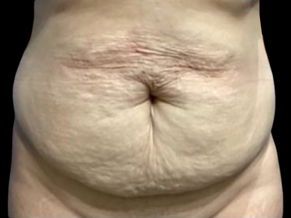 Case--21259 | Before Tummy Tuck