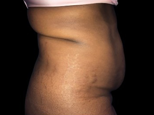 Case--21272 | Before Tummy Tuck