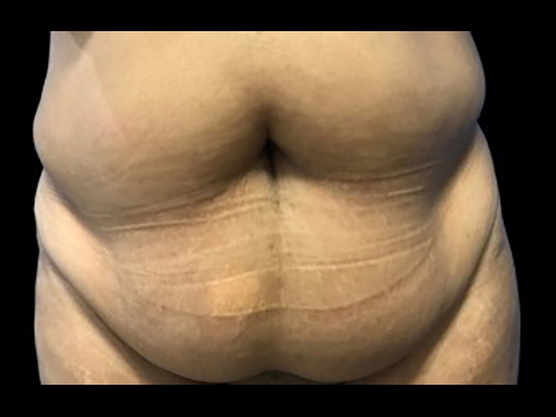 Case--21265 | Before Tummy Tuck