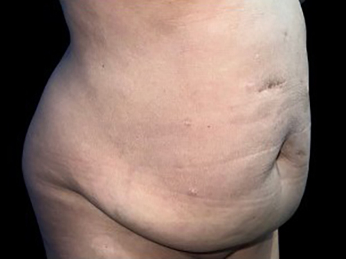 Case--21260 | Before Tummy Tuck