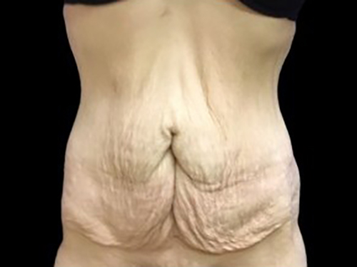 Case--21277 | Before Tummy Tuck