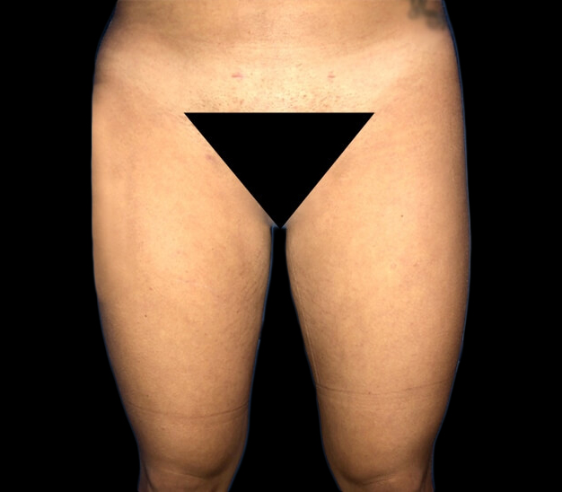 Case--21100 | After Liposuction