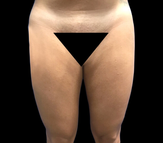 Case--21100 | Before Liposuction