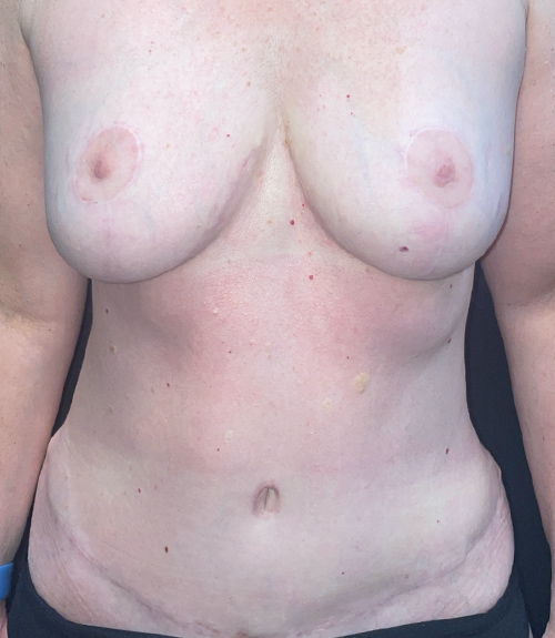 Case--6804 | After Mommy Makeover