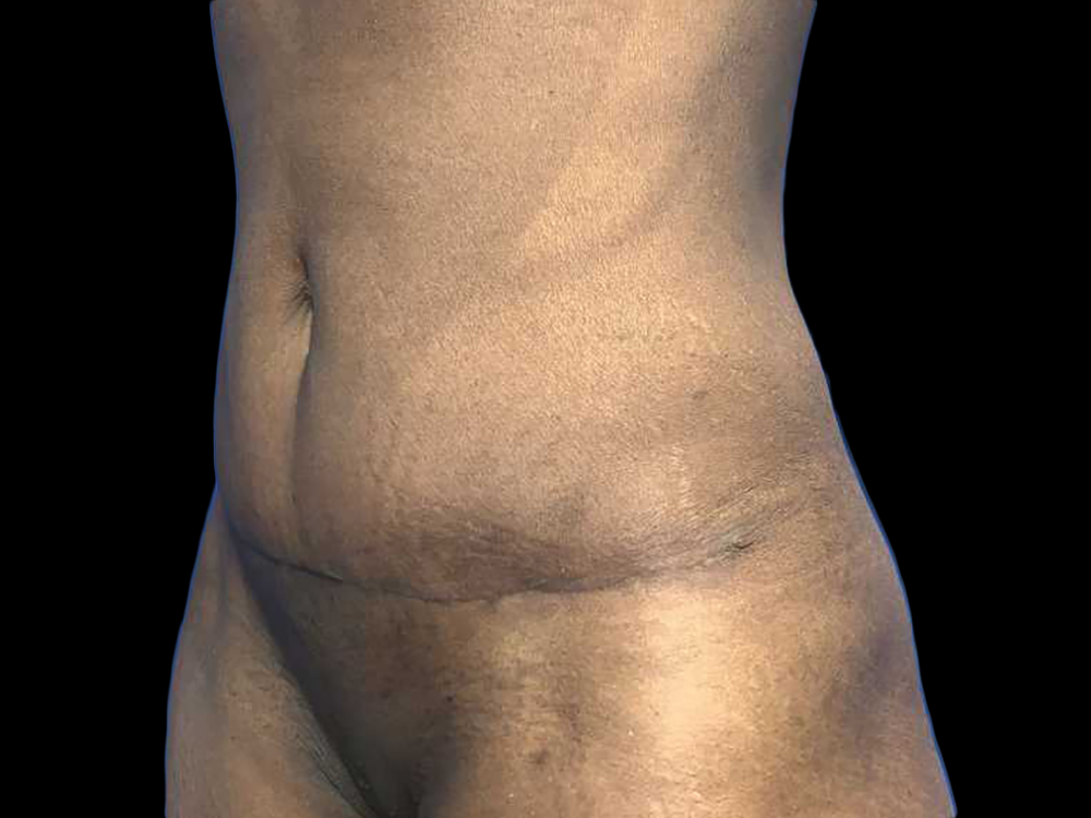 Case--19363 | After Tummy Tuck