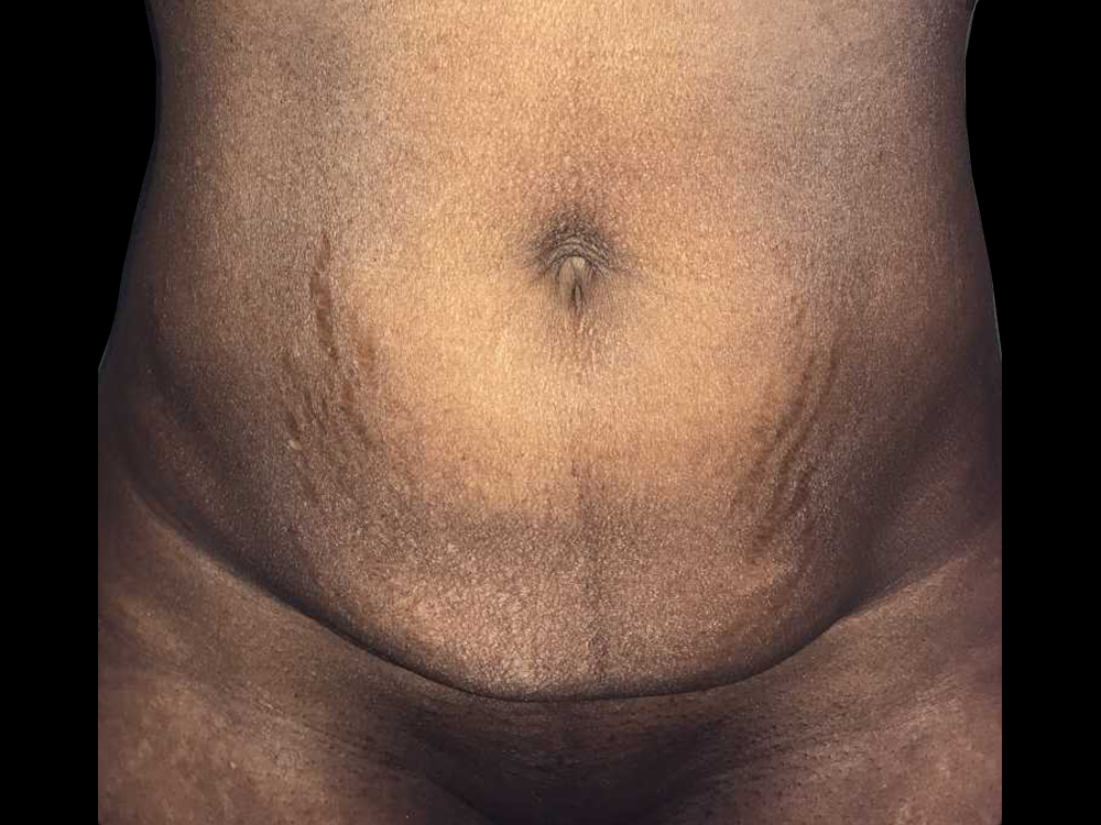 Case--19363 | Before Tummy Tuck