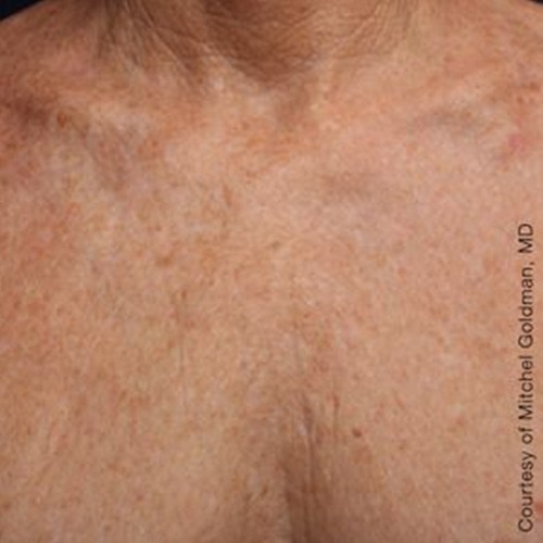 Case--21185 | After Ultherapy Chest