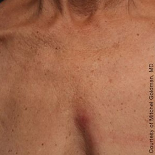 Case--21186 | After Ultherapy Chest