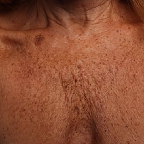 Case--21187 | Before Ultherapy Chest