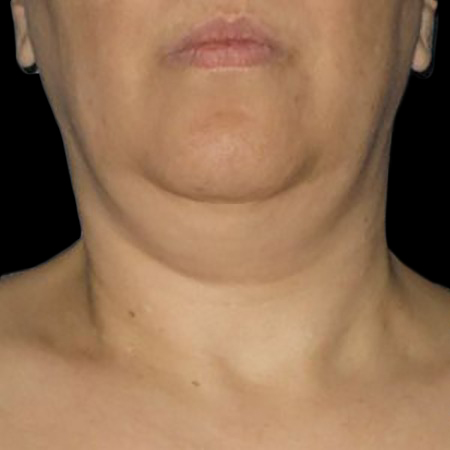 Case--21195 | Before Ultherapy Face