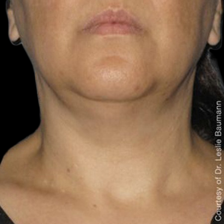 Case--21195 | After Ultherapy Face