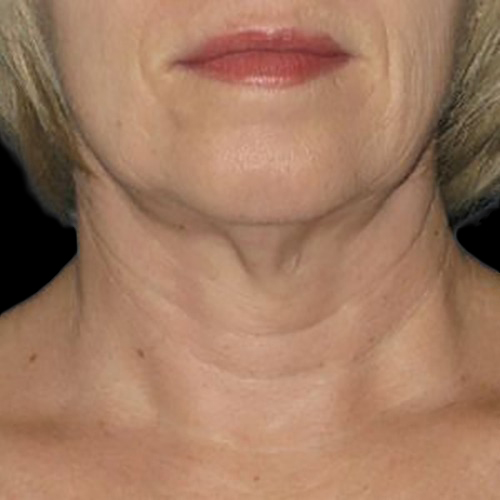 Case--21197 | Before Ultherapy Face