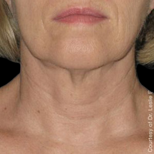 Case--21197 | After Ultherapy Face
