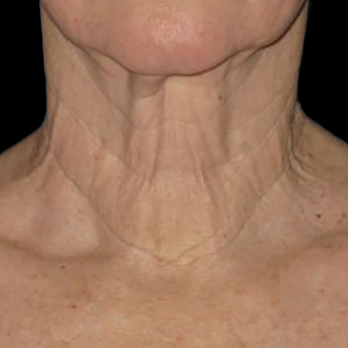 Case--21199 | Before Ultherapy Face