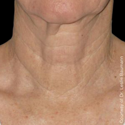 Case--21199 | After Ultherapy Face