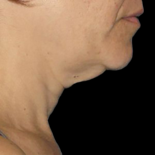 Case--21206 | Before Ultherapy Face