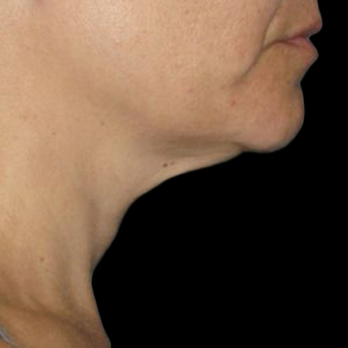 Case--21206 | After Ultherapy Face